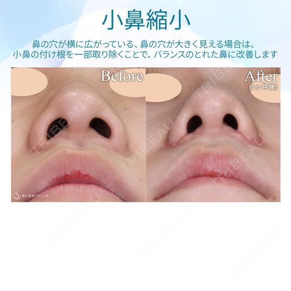 【10代女性・小鼻を小さく】小鼻縮小術 30日後 メイン用