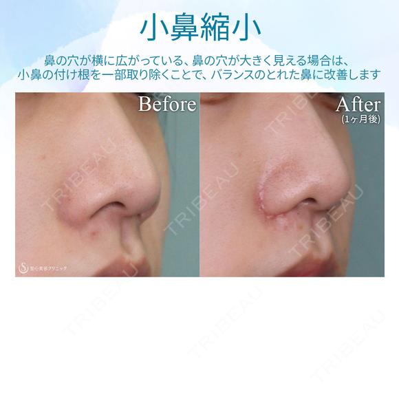 【10代女性・小鼻を小さく】小鼻縮小術 30日後 メイン用
