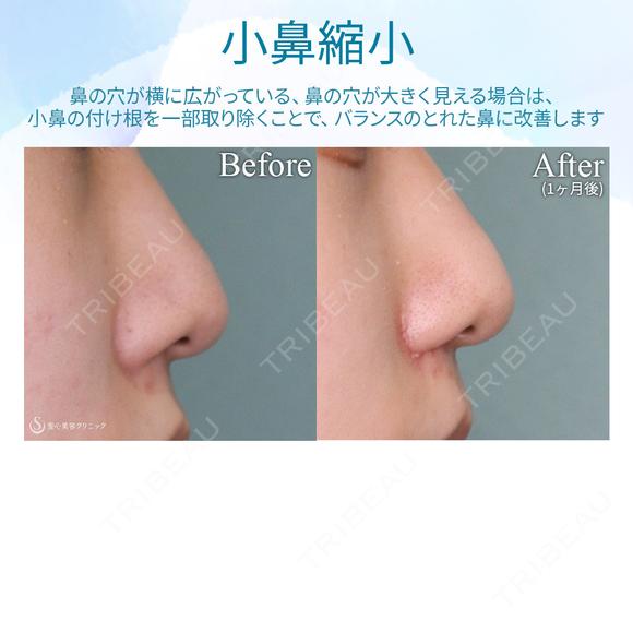 【10代女性・小鼻を小さく】小鼻縮小術 30日後 メイン用