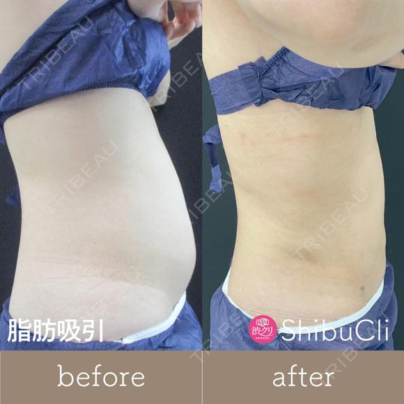 脂肪吸引 after画像 メイン用