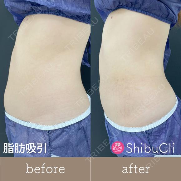 脂肪吸引 before画像 メイン用