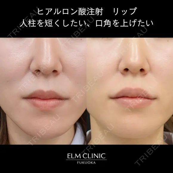 リップヒアルロン酸 before画像 メイン用