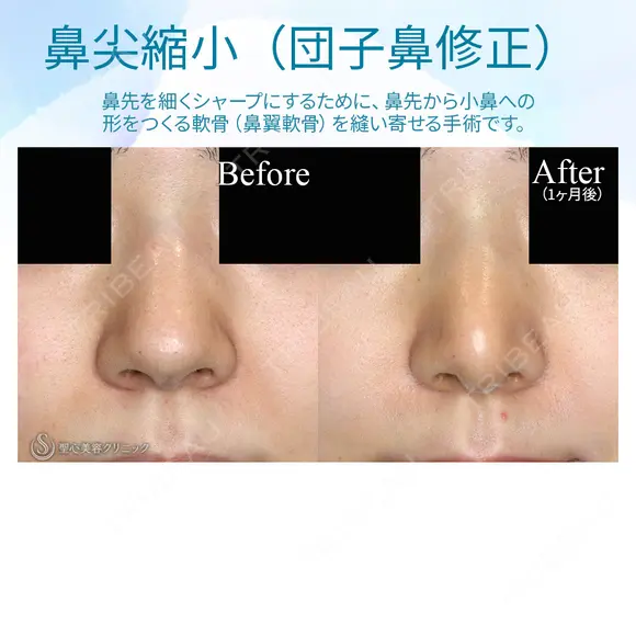 【20代女性・耳介軟骨は不要】鼻尖縮小術+α法（1ヶ月後） 30日後 メイン用