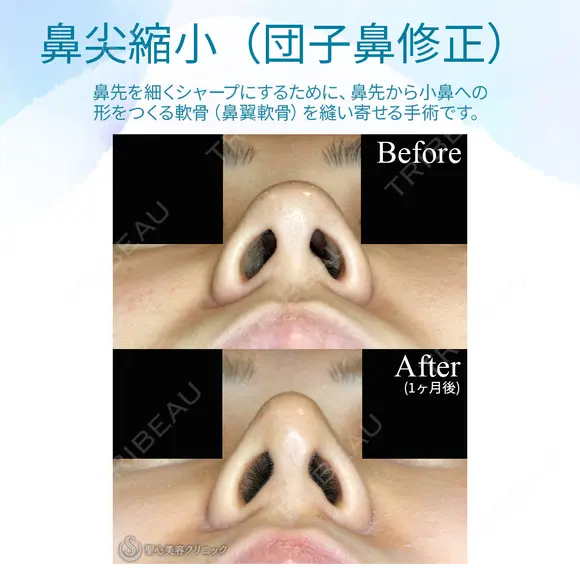 【20代女性・耳介軟骨は不要】鼻尖縮小術+α法（1ヶ月後） 30日後 メイン用