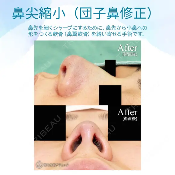 【20代女性・耳介軟骨は不要】鼻尖縮小術+α法（1ヶ月後） 30日後 メイン用
