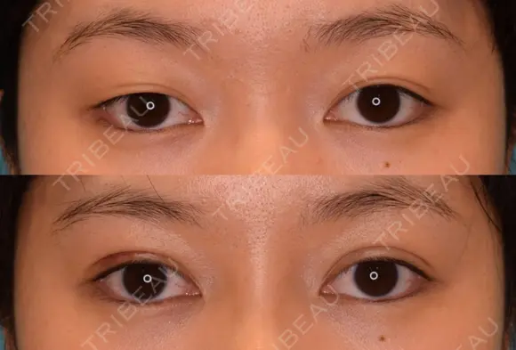 切開式二重 before画像 メイン用