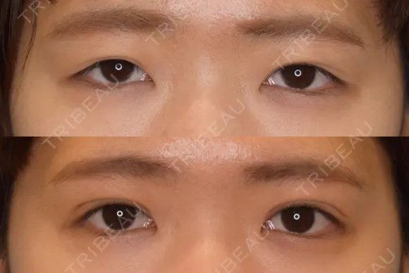 切開式二重 60日後 メイン用