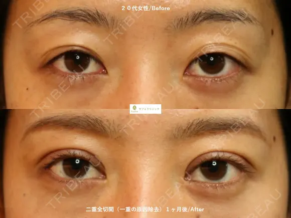 切開式二重 60日後 メイン用