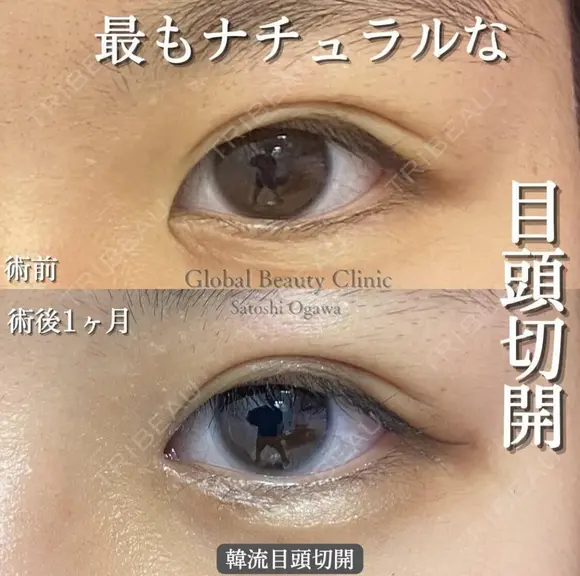 韓流目頭切開 before画像 メイン用