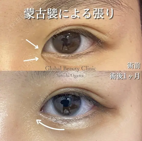 韓流目頭切開 after画像 メイン用