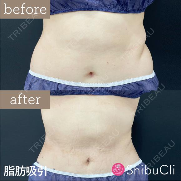 脂肪吸引 after画像 メイン用