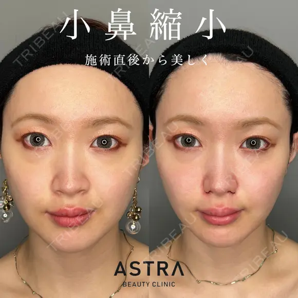 小鼻縮小 before画像 メイン用