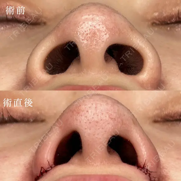 小鼻縮小 0日後 メイン用