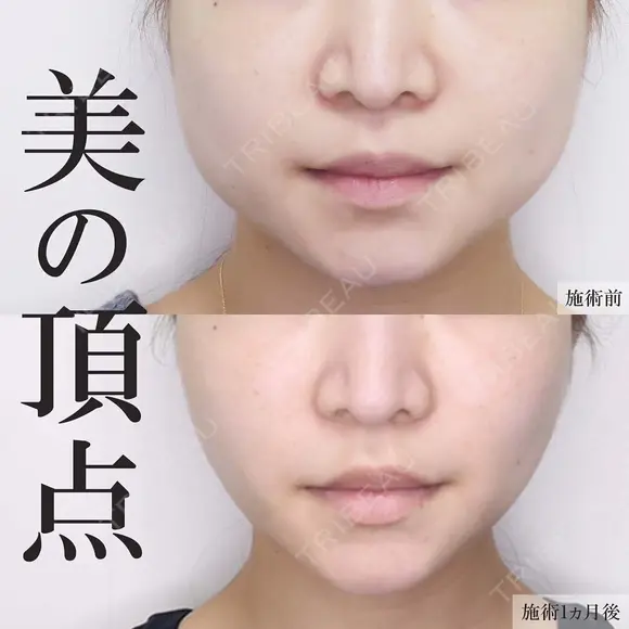 美ラインの複合小顔術😌糸リフト＆脂肪吸引 before画像 メイン用