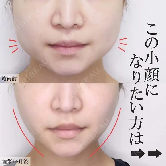 美ラインの複合小顔術😌糸リフト＆脂肪吸引 30日後 メイン用