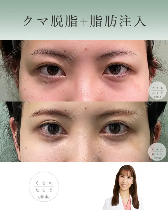 クマ脱脂＋脂肪注入 after画像 メイン用