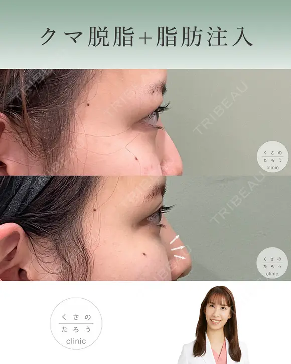 クマ脱脂＋脂肪注入 after画像 メイン用