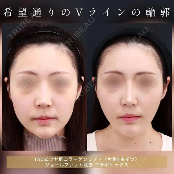 希望通りのVライン輪郭🦊 30日後 メイン用