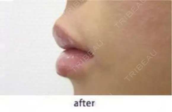 口唇ヒアルロン酸注入 after画像 メイン用