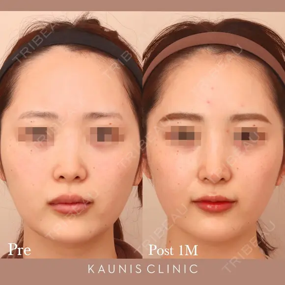 鼻中隔延長、鼻尖形成、隆鼻術（オーダーメードプロテーゼ） after画像 メイン用