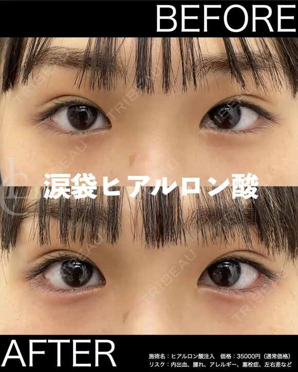 涙袋ヒアルロン酸 before画像 メイン用