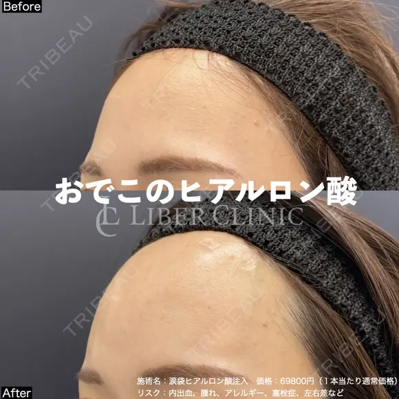 おでこのヒアルロン酸 before画像 メイン用