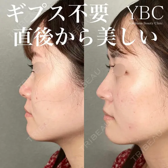 【鼻整形の複合手術】 before画像 メイン用