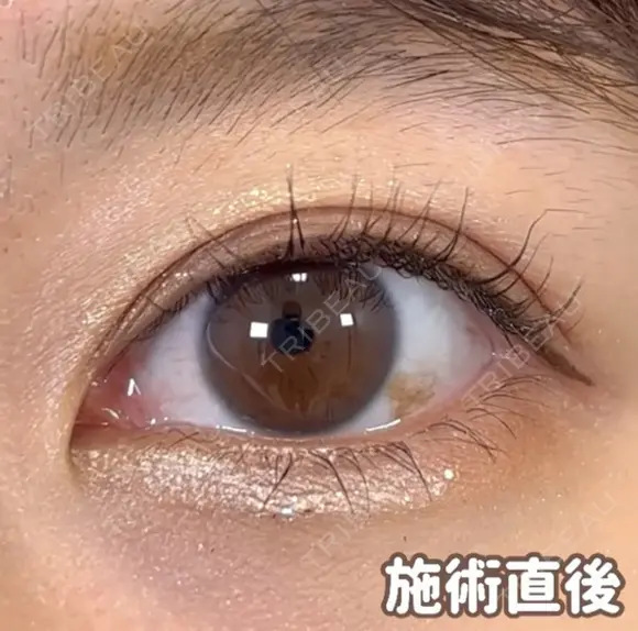 ☆BELINDA二重術 0日後 メイン用