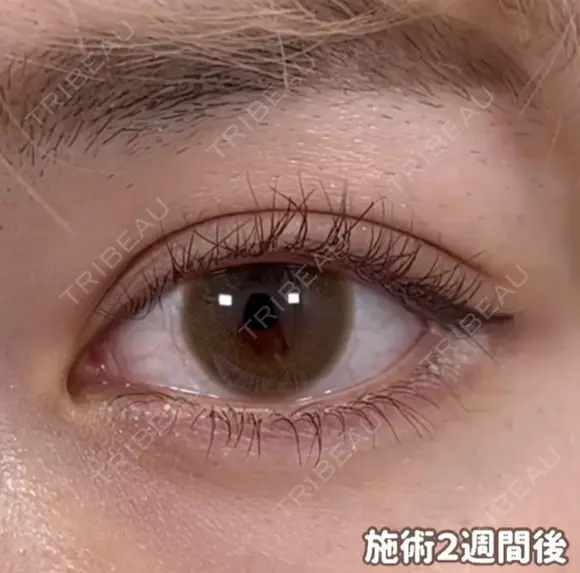 ☆BELINDA二重術 14日後 メイン用