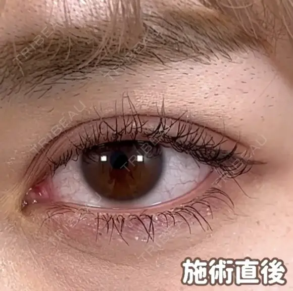 ☆BELINDA二重術 0日後 メイン用