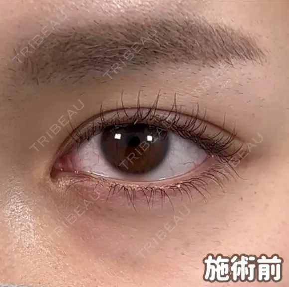 ☆BELINDA二重術 before画像 メイン用