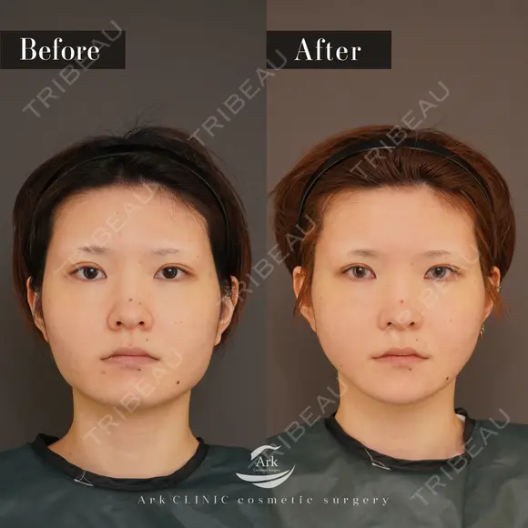 輪郭3点（エラ＋頬骨＋オトガイ） before画像 メイン用