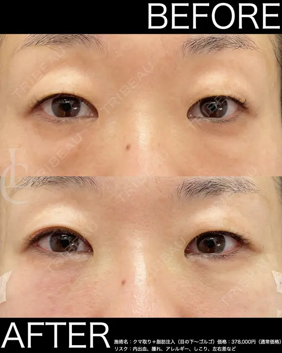術直後からこの仕上がり！クマ取り＋脂肪注入 after画像 メイン用