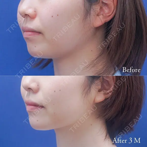 顎元のもたつきを顔の脂肪吸引で解消😄 before画像 メイン用
