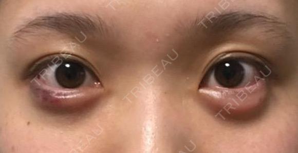 【ヒアルロン酸の再注入無料!】イセアの涙袋形成 0日後 メイン用