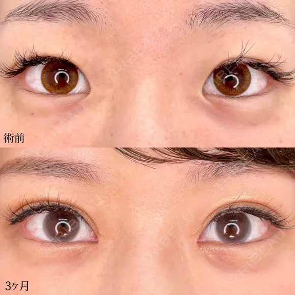 埋没法二重術（クイックシンデレラ・トリプル）＋MD式目頭切開 90日後 メイン用