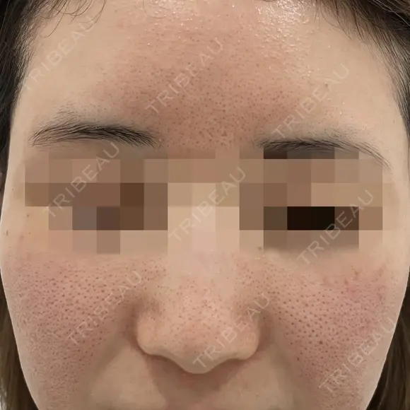 ポテンツァ　ドラッグデリバリー（マックーム使用） before画像 メイン用