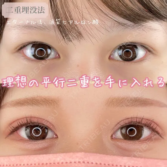 二重埋没法(エターナル法) before画像 メイン用