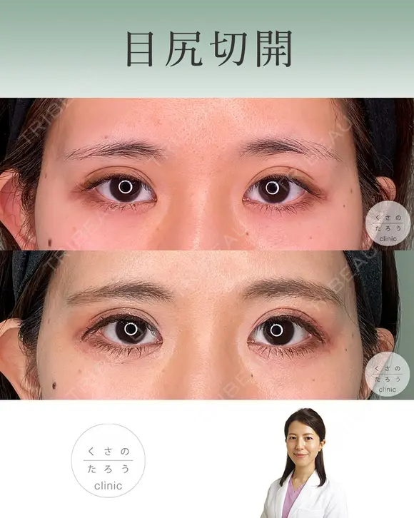 目尻切開 after画像 メイン用