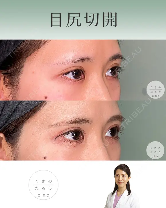目尻切開 after画像 メイン用