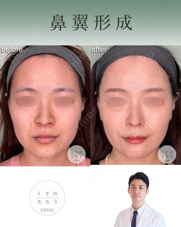 鼻翼縮小 after画像 メイン用