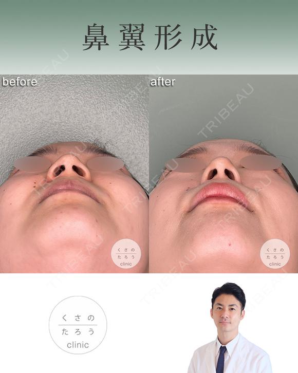 鼻翼縮小 after画像 メイン用