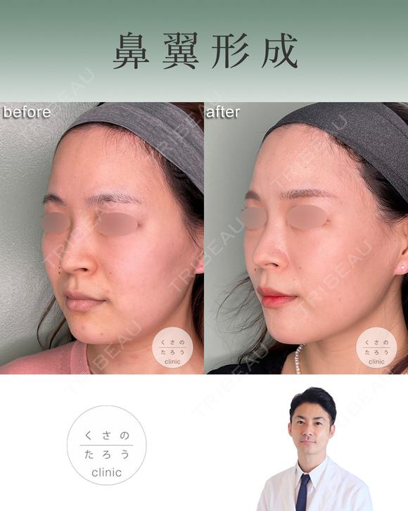 鼻翼縮小 after画像 メイン用