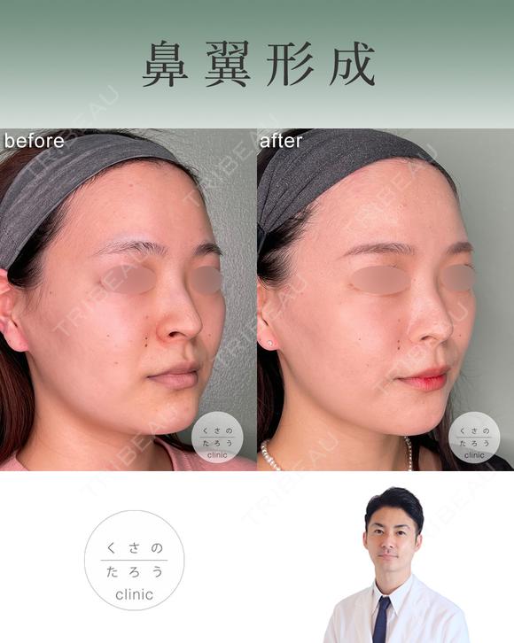 鼻翼縮小 after画像 メイン用