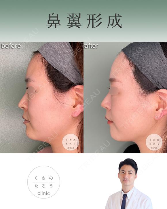 鼻翼縮小 after画像 メイン用