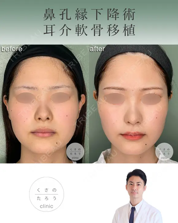 鼻孔縁下降術＋耳介軟骨移植 after画像 メイン用