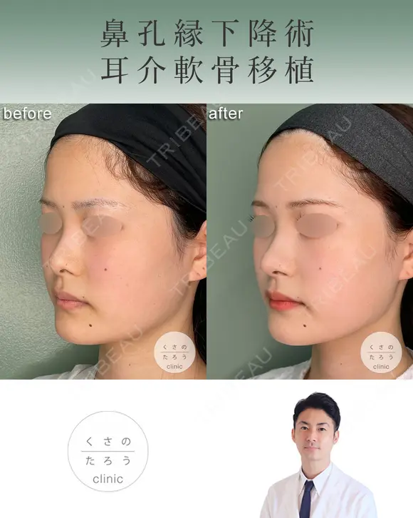 鼻孔縁下降術＋耳介軟骨移植 after画像 メイン用