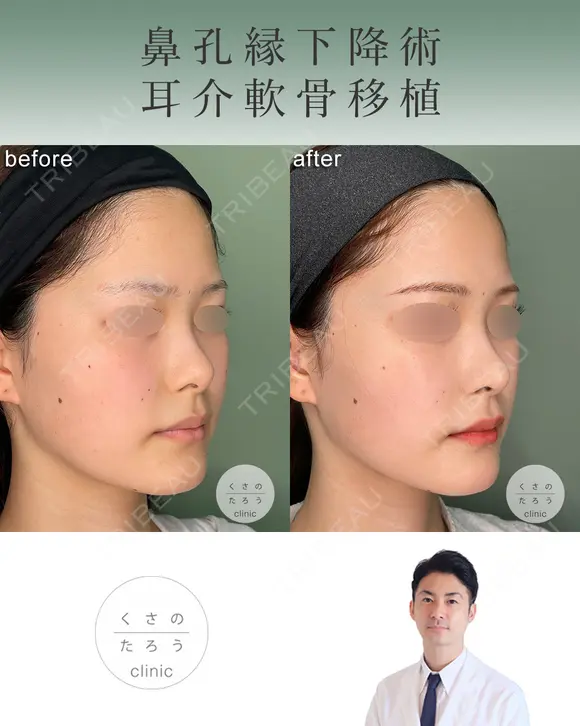 鼻孔縁下降術＋耳介軟骨移植 after画像 メイン用