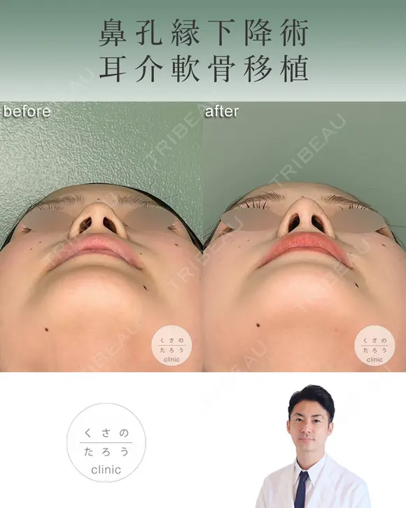 鼻孔縁下降術＋耳介軟骨移植 after画像 メイン用