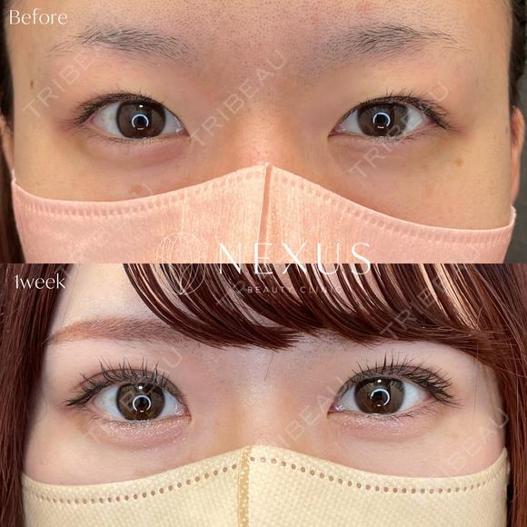 ネクサスアイズ(埋没法) before画像 メイン用